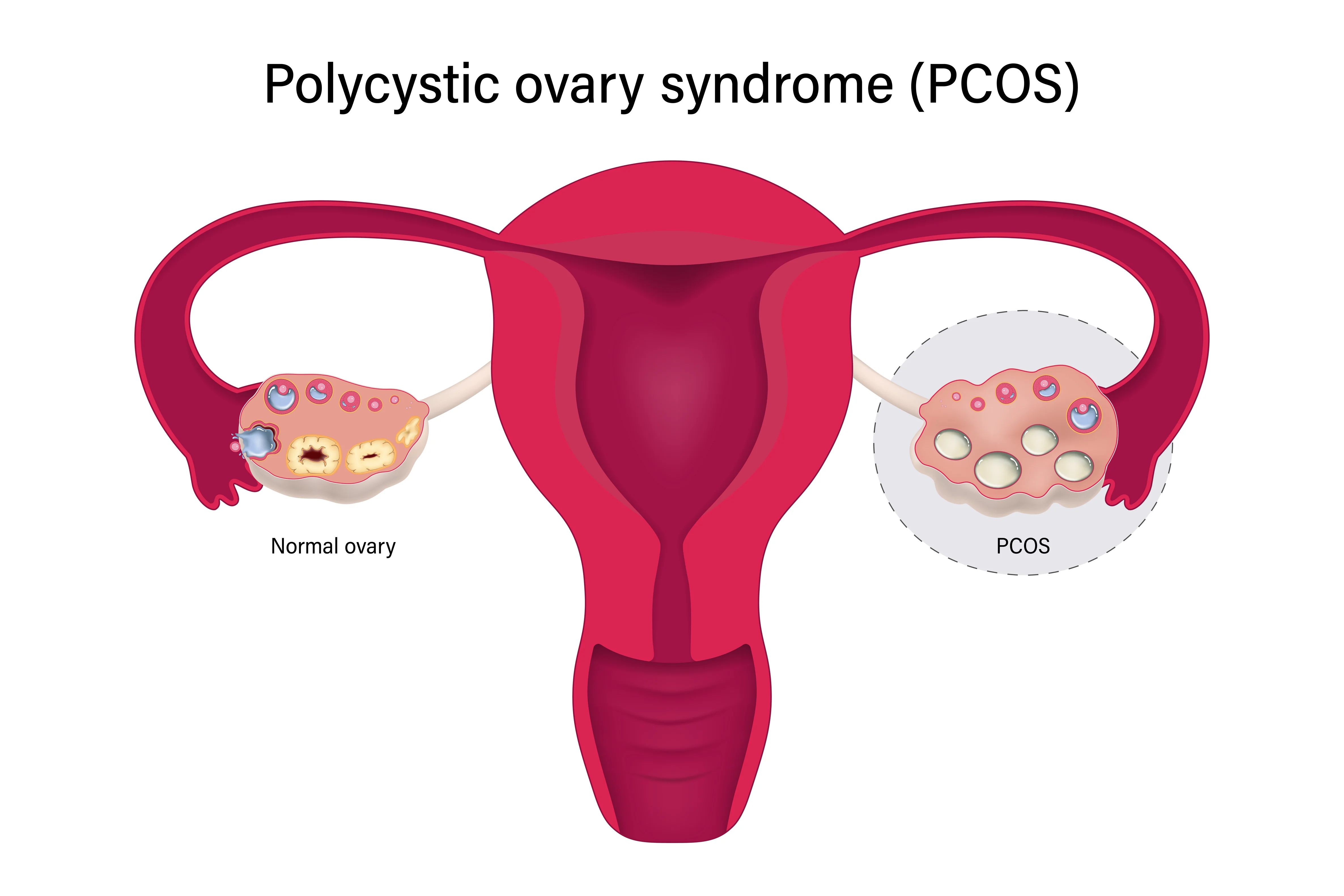 PCOS