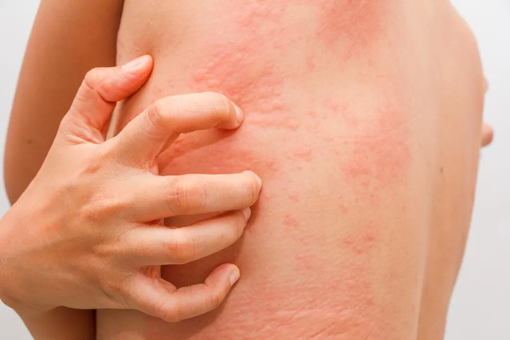 Žihľavka - časté kožné ochorenie. Trápi aj vás?