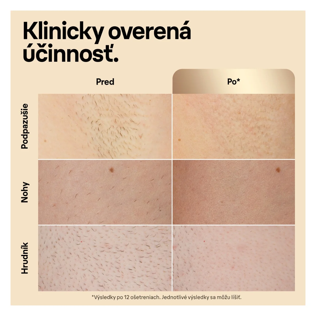 Braun IPL Silk·expert Pro 5, Odstraňovanie Chĺpkov v Pohodlí Domova, S Puzdro, 1 Hlavica, PL5052 1×1 ks, epilátor